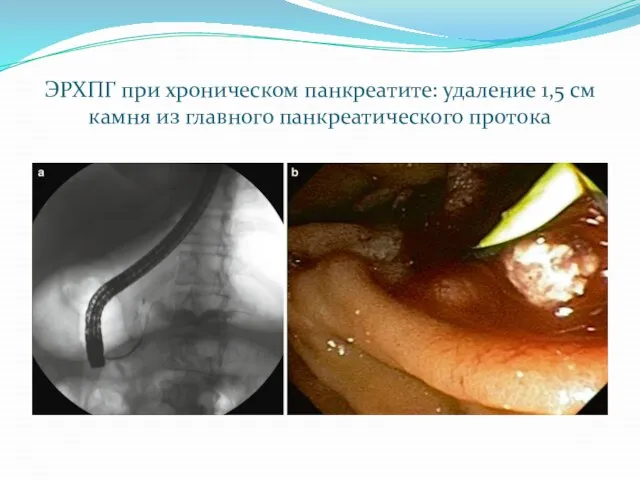 ЭРХПГ при хроническом панкреатите: удаление 1,5 см камня из главного панкреатического протока