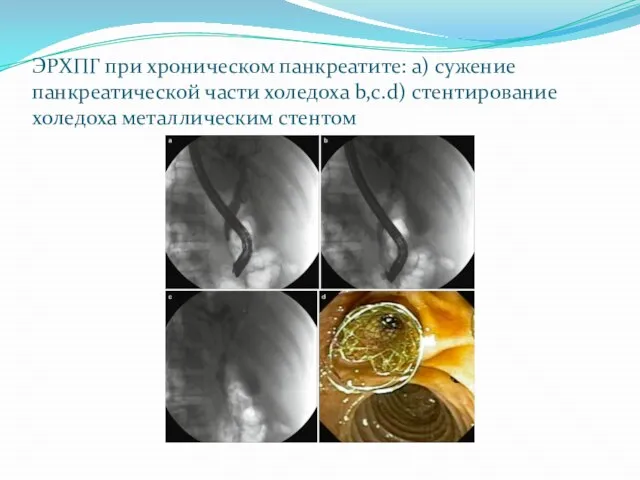 ЭРХПГ при хроническом панкреатите: а) сужение панкреатической части холедоха b,c.d) стентирование холедоха металлическим стентом