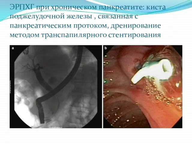 ЭРПХГ при хроническом панкреатите: киста поджелудочной железы , связанная с панкреатическим протоком, дренирование методом транспапилярного стентирования