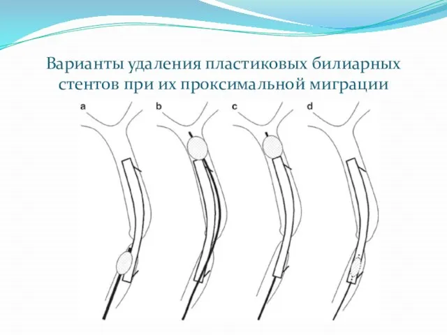 Варианты удаления пластиковых билиарных стентов при их проксимальной миграции