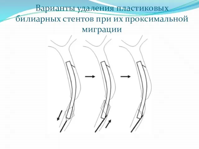 Варианты удаления пластиковых билиарных стентов при их проксимальной миграции