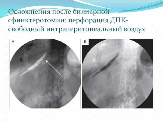Осложнения после билиарной сфинктеротомии: перфорация ДПК-свободный интраперитонеальный воздух