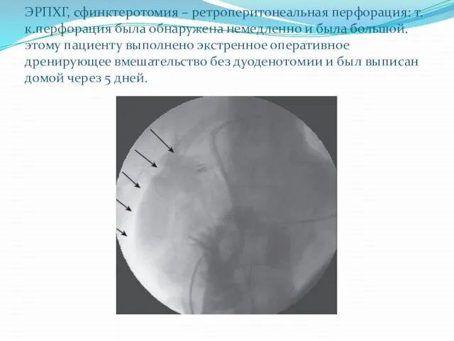 ЭРПХГ, сфинктеротомия – ретроперитонеальная перфорация: т.к.перфорация была обнаружена немедленно и была большой.