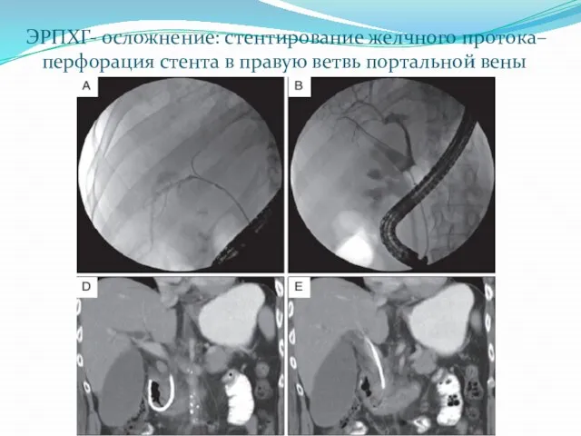 ЭРПХГ- осложнение: стентирование желчного протока– перфорация стента в правую ветвь портальной вены