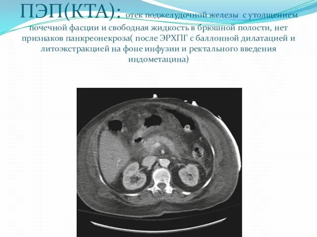 ПЭП(КТА): отек поджелудочной железы с утолщением почечной фасции и свободная жидкость в