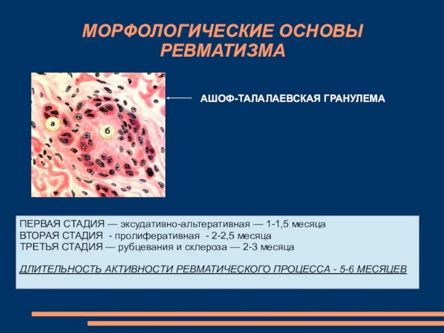 МОРФОЛОГИЧЕСКИЕ ОСНОВЫ РЕВМАТИЗМА АШОФ-ТАЛАЛАЕВСКАЯ ГРАНУЛЕМА ПЕРВАЯ СТАДИЯ — эксудативно-альтеративная — 1-1,5 месяца