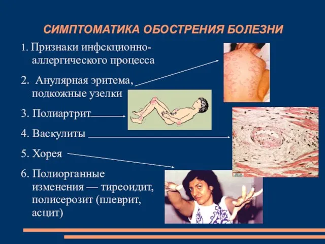 СИМПТОМАТИКА ОБОСТРЕНИЯ БОЛЕЗНИ 1. Признаки инфекционно-аллергического процесса 2. Анулярная эритема, подкожные узелки