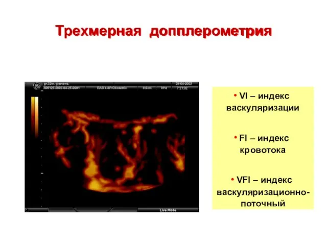 Трехмерная допплерометрия VI – индекс васкуляризации FI – индекс кровотока VFI – индекс васкуляризационно-поточный