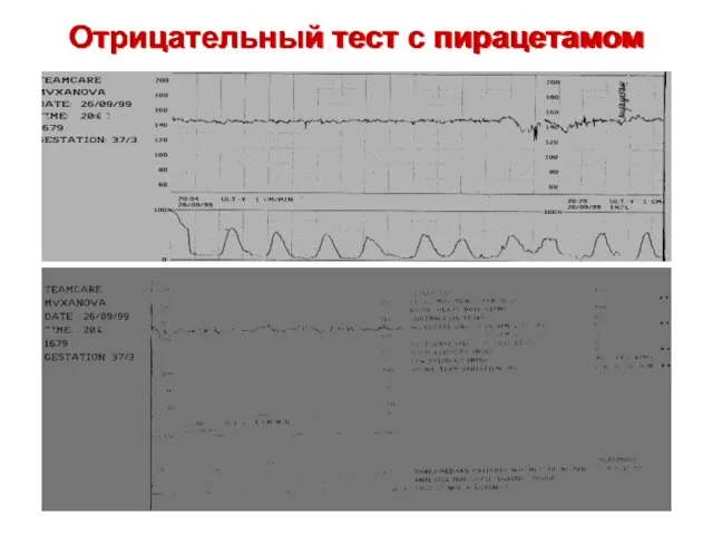 Отрицательный тест с пирацетамом