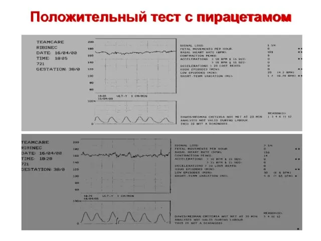 Положительный тест с пирацетамом