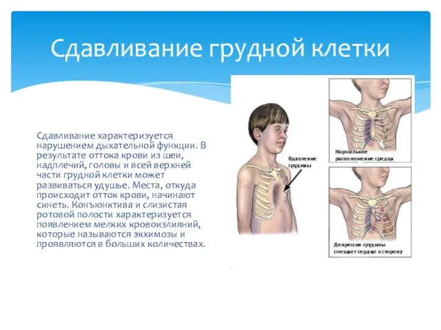 Сдавливание грудной клетки Сдавливание характеризуется нарушением дыхательной функции. В результате оттока крови