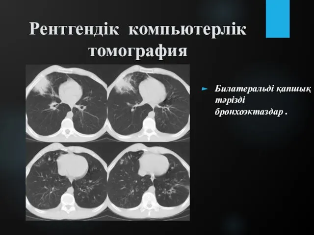 Рентгендік компьютерлік томография Билатеральді қапшық тәрізді бронхоэктаздар .