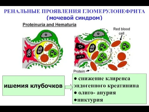 РЕНАЛЬНЫЕ ПРОЯВЛЕНИЯ ГЛОМЕРУЛОНЕФРИТА (мочевой синдром) ● снижение клиренса эндогенного креатинина ● олиго- анурия ●никтурия ишемия клубочков