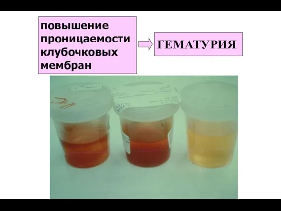 повышение проницаемости клубочковых мембран ГЕМАТУРИЯ