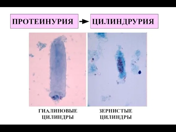 ПРОТЕИНУРИЯ ЦИЛИНДРУРИЯ ГИАЛИНОВЫЕ ЦИЛИНДРЫ ЗЕРНИСТЫЕ ЦИЛИНДРЫ