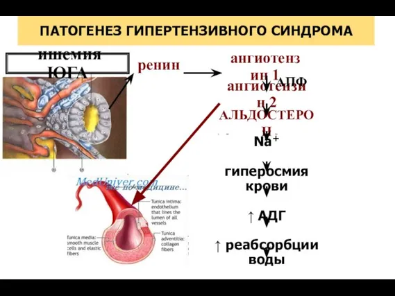 ↑ реабсорбции Na+ гиперосмия крови ↑ АДГ ↑ реабсорбции воды ↑ ОЦК