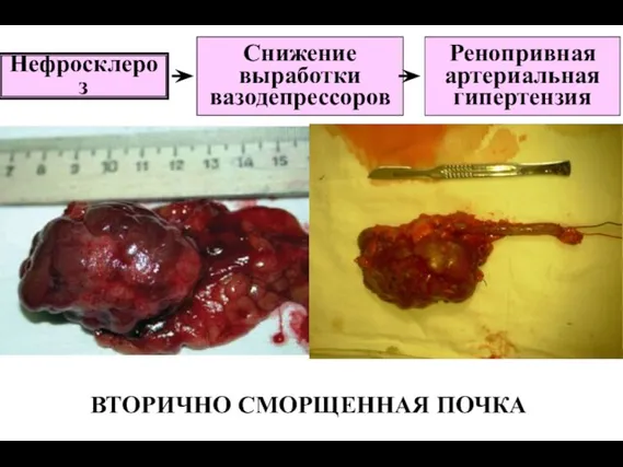 ВТОРИЧНО СМОРЩЕННАЯ ПОЧКА Нефросклероз Снижение выработки вазодепрессоров Ренопривная артериальная гипертензия