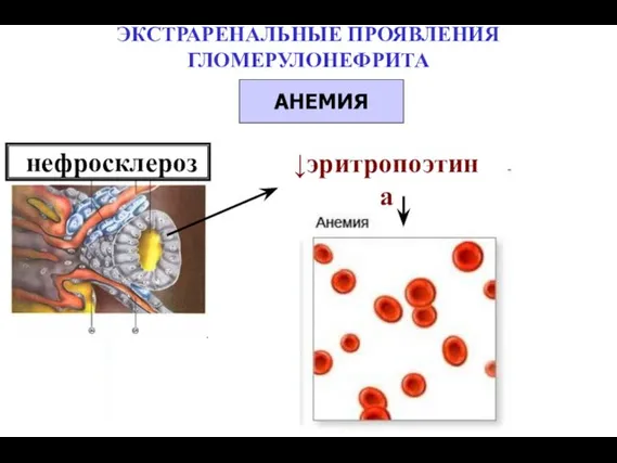 ↓эритропоэтина нефросклероз ЭКСТРАРЕНАЛЬНЫЕ ПРОЯВЛЕНИЯ ГЛОМЕРУЛОНЕФРИТА АНЕМИЯ