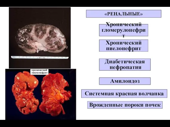 Хронический гломерулонефрит Хронический пиелонефрит Диабетическая нефропатия Амилоидоз Системная красная волчанка Врожденные пороки почек «РЕНАЛЬНЫЕ»