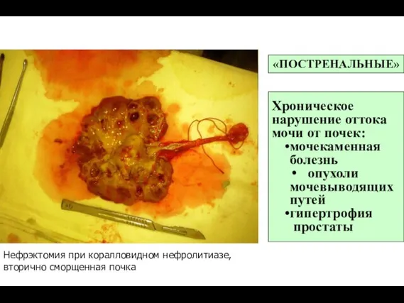 Нефрэктомия при коралловидном нефролитиазе, вторично сморщенная почка «ПОСТРЕНАЛЬНЫЕ» Хроническое нарушение оттока мочи
