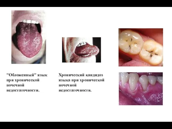 "Обложенный" язык при хронической почечной недостаточности. Хронический кандидоз языка при хронической почечной недостаточности.