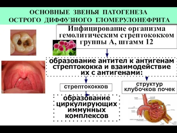 ОСНОВНЫЕ ЗВЕНЬЯ ПАТОГЕНЕЗА ОСТРОГО ДИФФУЗНОГО ГЛОМЕРУЛОНЕФРИТА