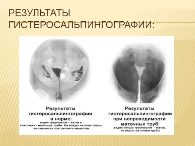 РЕЗУЛЬТАТЫ ГИСТЕРОСАЛЬПИНГОГРАФИИ: