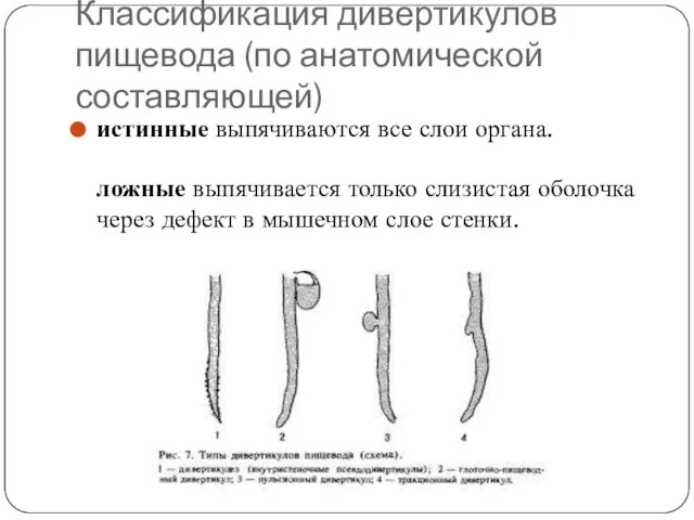 Классификация дивертикулов пищевода (по анатомической составляющей) истинные выпячиваются все слои органа. ложные