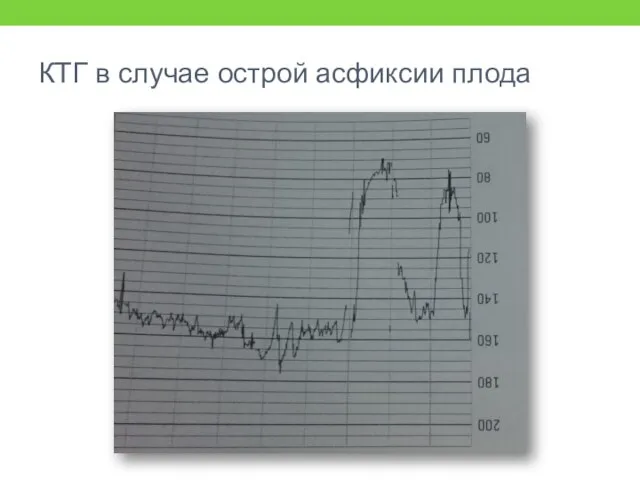 КТГ в случае острой асфиксии плода