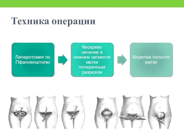 Техника операции