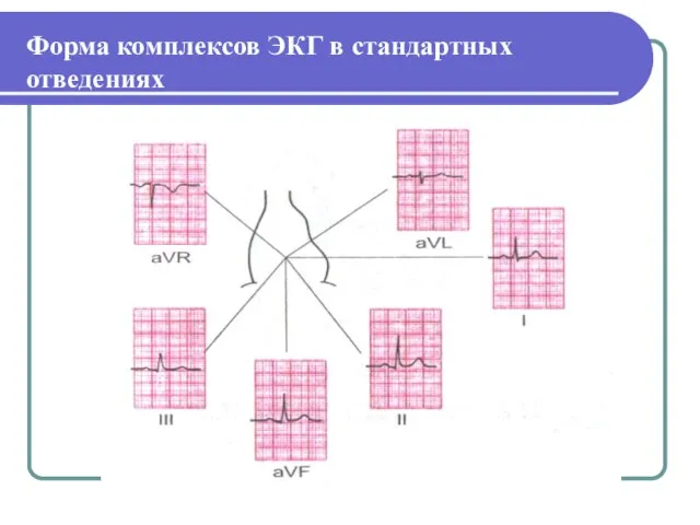 Форма комплексов ЭКГ в стандартных отведениях