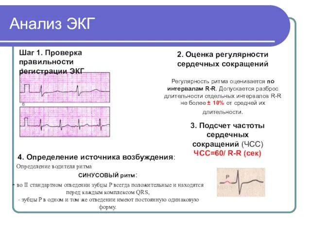 Анализ ЭКГ Шаг 1. Проверка правильности регистрации ЭКГ 2. Оценка регулярности сердечных