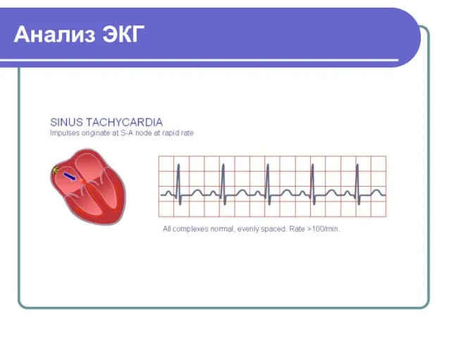 Анализ ЭКГ