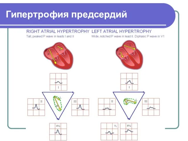 Гипертрофия предсердий