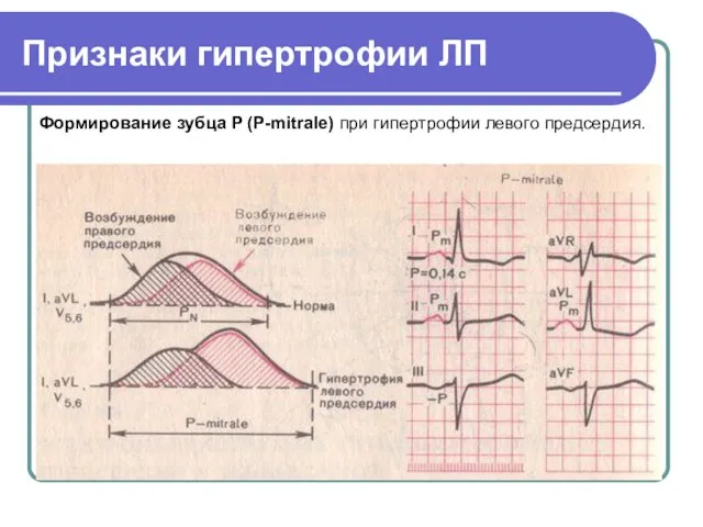 Признаки гипертрофии ЛП Формирование зубца P (P-mitrale) при гипертрофии левого предсердия.