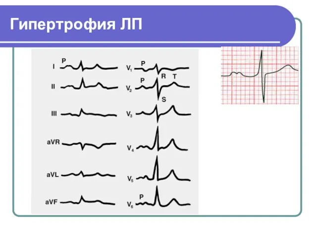 Гипертрофия ЛП