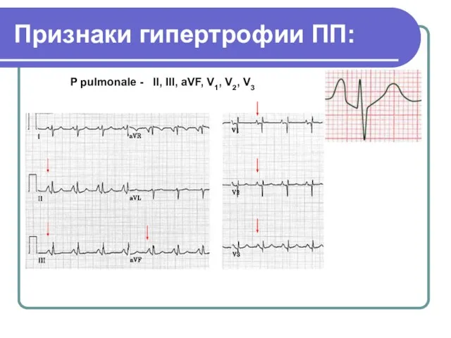 Признаки гипертрофии ПП: P pulmonale - II, III, aVF, V1, V2, V3