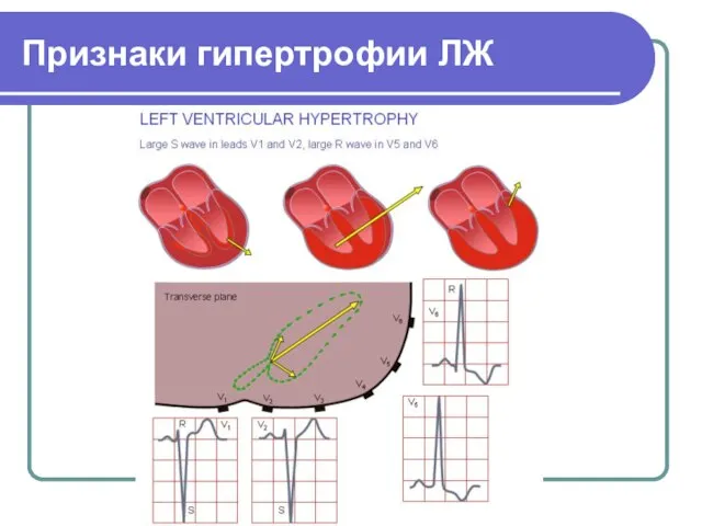 Признаки гипертрофии ЛЖ