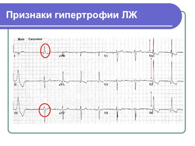 Признаки гипертрофии ЛЖ