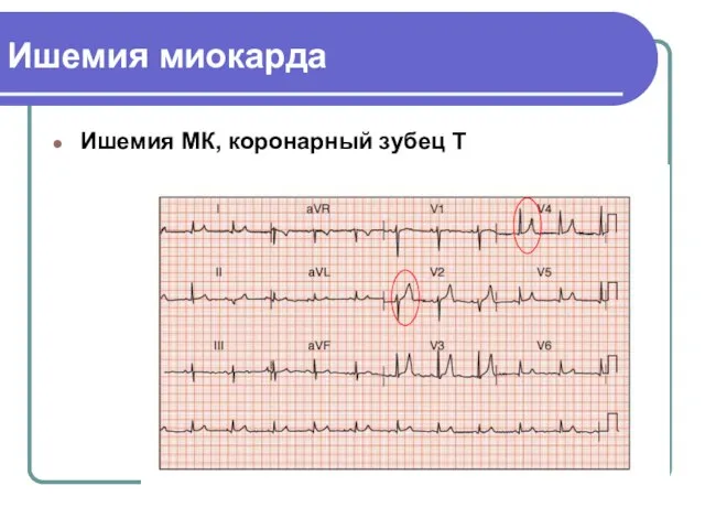 Ишемия миокарда Ишемия МК, коронарный зубец Т