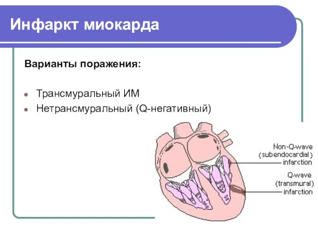 Инфаркт миокарда Варианты поражения: Трансмуральный ИМ Нетрансмуральный (Q-негативный)