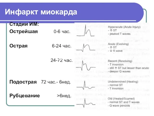 Инфаркт миокарда Стадии ИМ: Острейшая 0-6 час. Острая 6-24 час. 24-72 час.