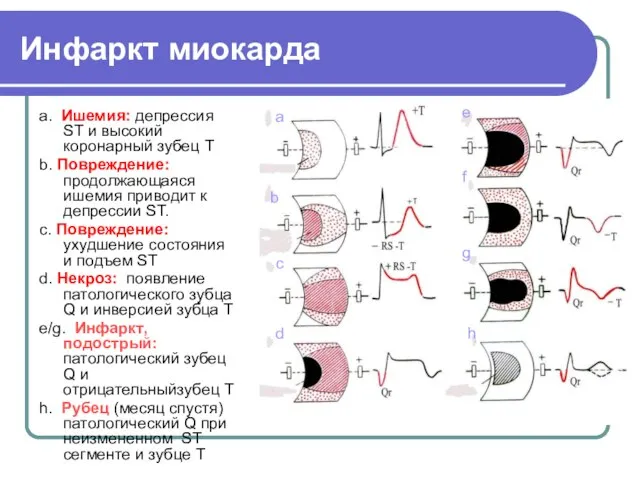 Инфаркт миокарда a. Ишемия: депрессия ST и высокий коронарный зубец Т b.