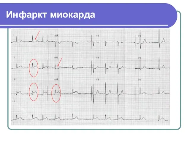 Инфаркт миокарда