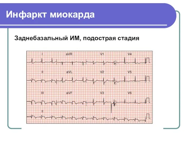 Инфаркт миокарда Заднебазальный ИМ, подострая стадия