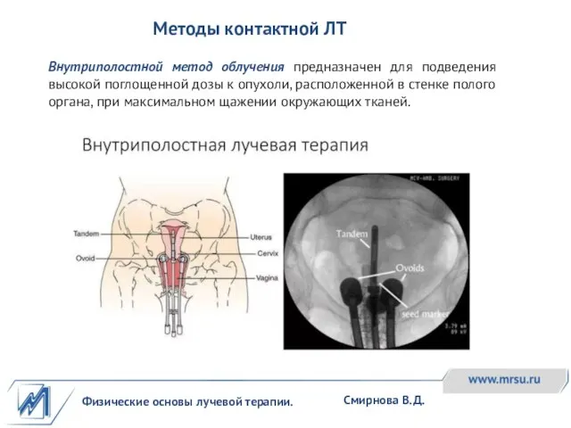 Физические основы лучевой терапии. Смирнова В.Д. Методы контактной ЛТ Внутриполостной метод облучения