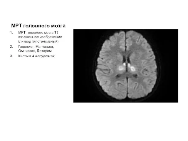 МРТ головного мозга МРТ головного мозга Т1 взвешенное изображение(ликвор гипотенсивный) Гадовист, Магневист,