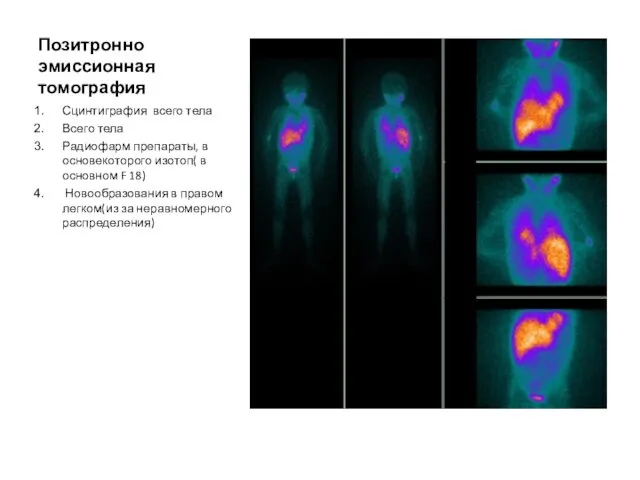 Позитронно эмиссионная томография Сцинтиграфия всего тела Всего тела Радиофарм препараты, в основекоторого