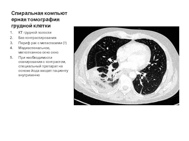 Спиральная компьютерная томография грудной клетки КТ грудной полости Без контрастирования Периф рак