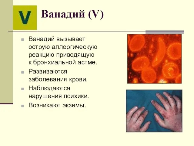 Ванадий (V) Ванадий вызывает острую аллергическую реакцию приводящую к бронхиальной астме. Развиваются